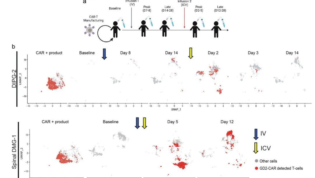 gd2-car t cell therapyfor h3k27m-mutated diffuse midline gliomas