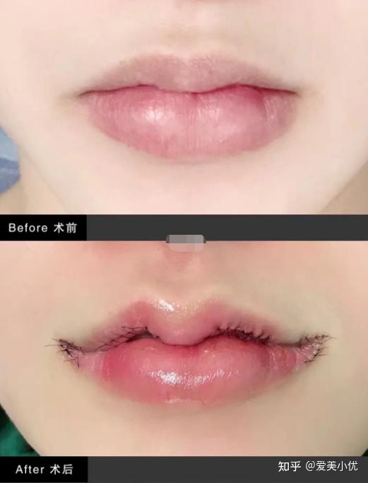 m唇手术前后对比照