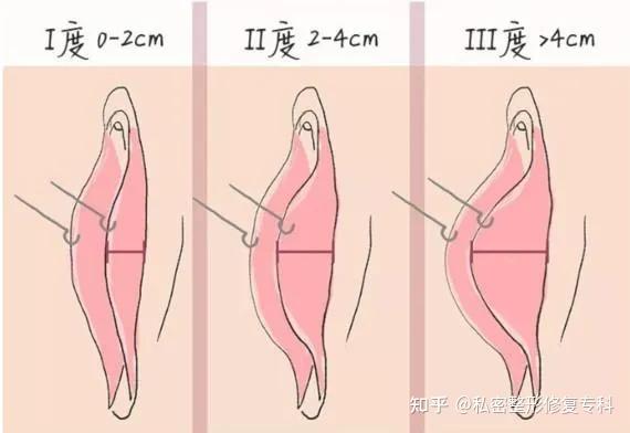 阴唇形状千千万 实在不行咱就换 知乎