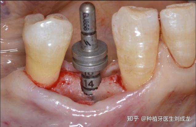 之後,安裝上癒合基臺,並用非吸收性單絲縫合線恰當縫合手術部位.