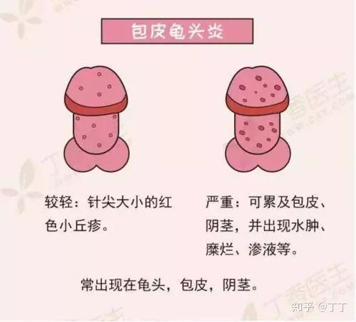 真菌也能感染到你的包皮