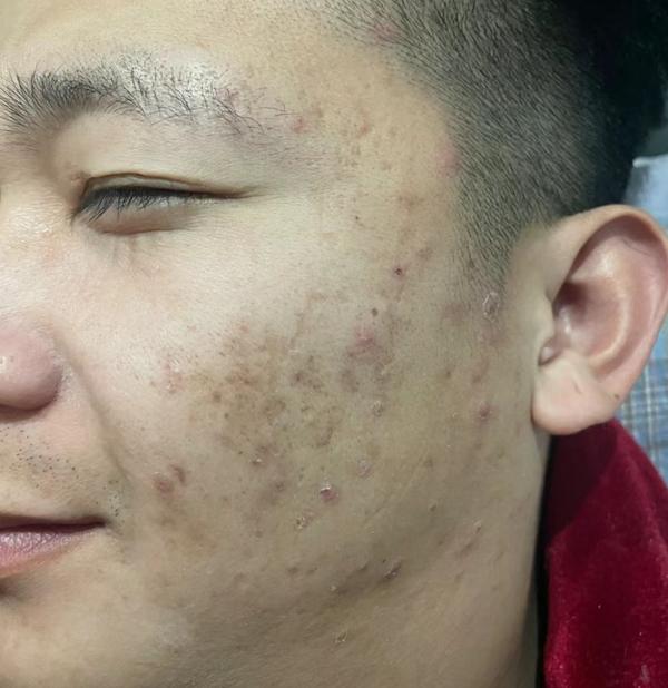 本人脸上出油很厉害,还有痘痘,通常早上洗完脸,下午又出了好多油,这时