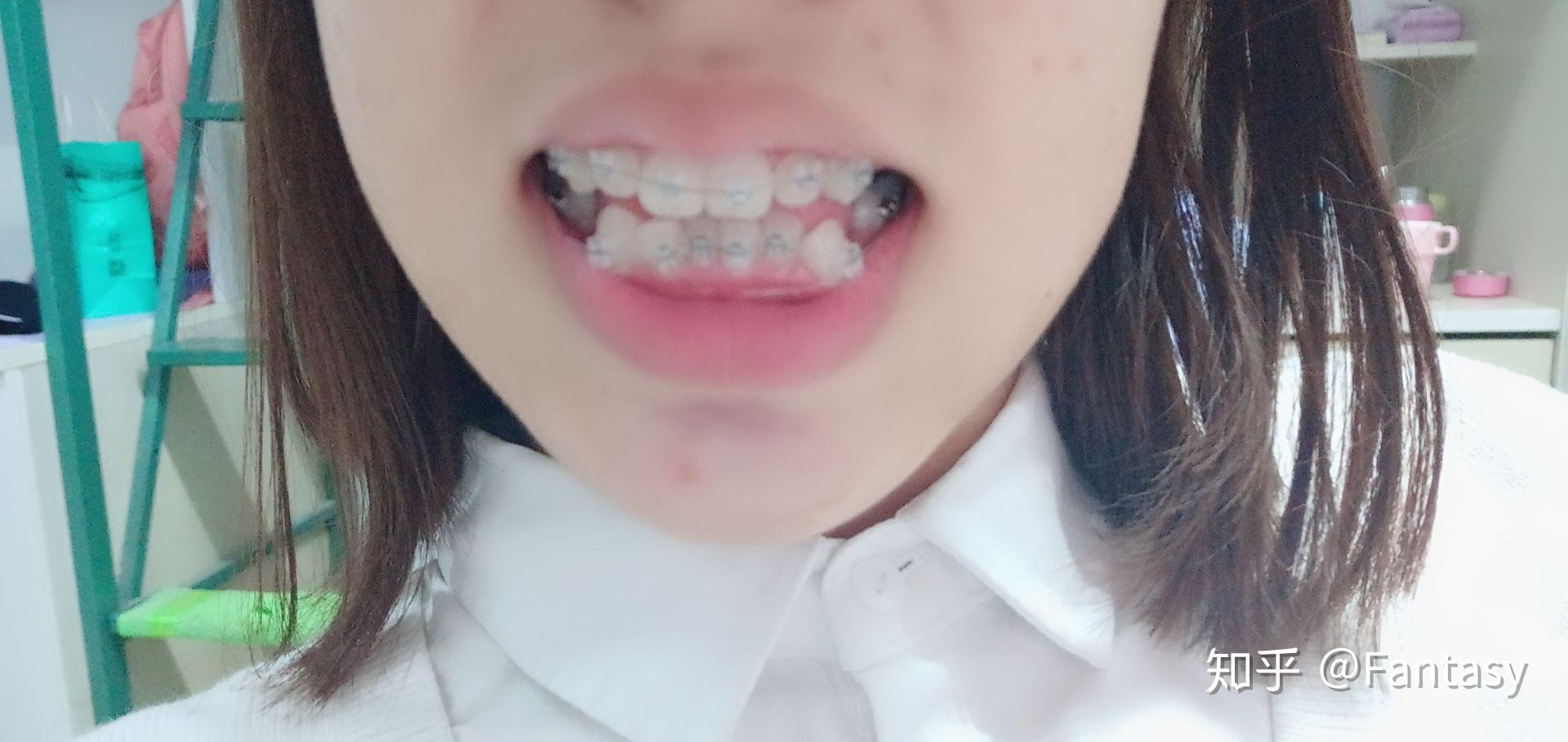 多少岁不可以矫正牙齿 v2-55331551582c556011f4ee581ebc6cb3_r.jpg