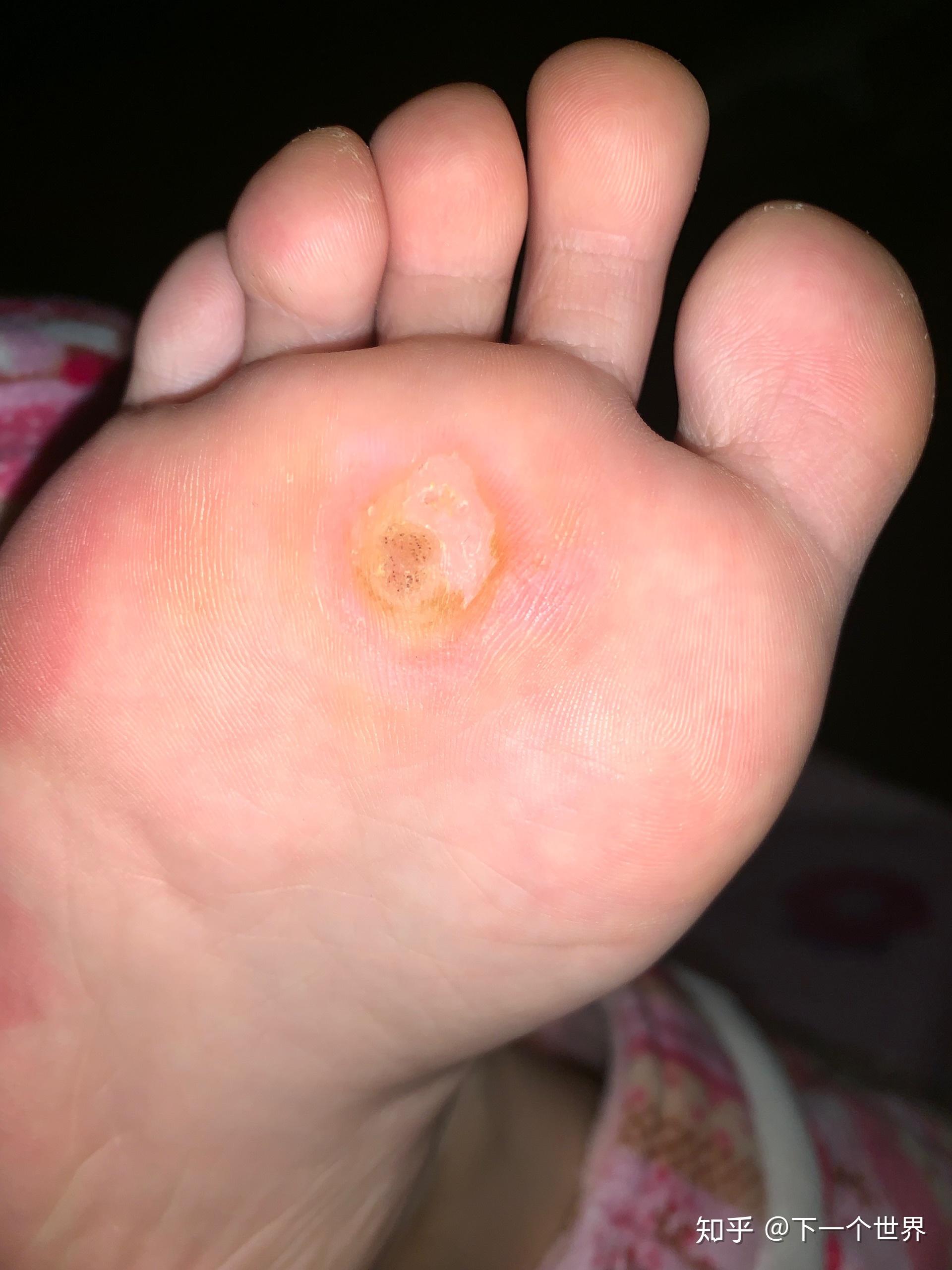 我的跖疣终于治好啦