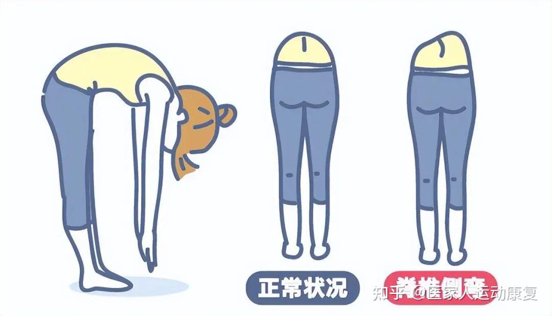 跷二郎腿易致脊柱侧弯该怎么纠正?一文带你理清脊柱侧弯! - 知乎