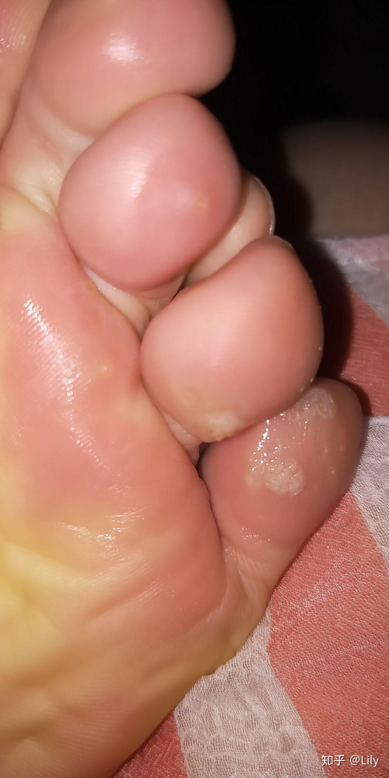 小护士的跖疣大作战03