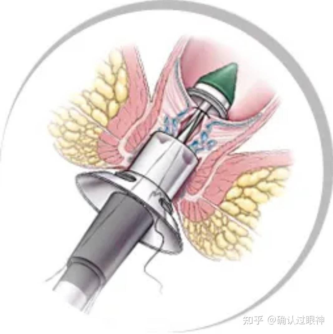 痔疮可以用手捏爆吗图片