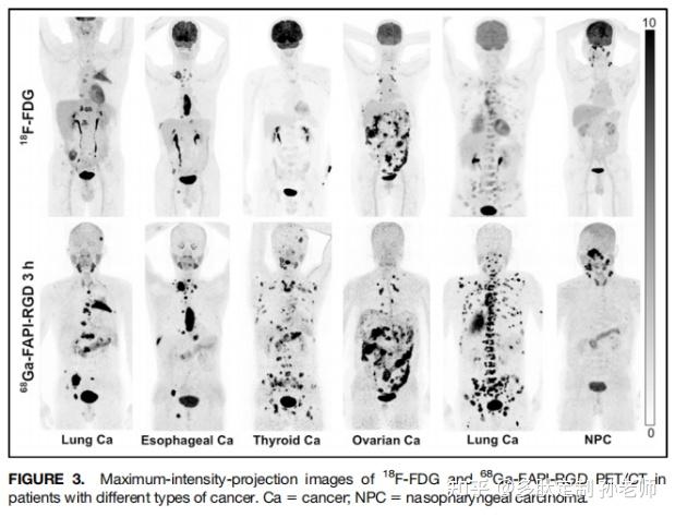 文献分享：68Ga-FAPI-RGD显像成纤维细胞活化蛋白FAP和整合素avb3对不同癌症类型中的临床评价 - 知乎