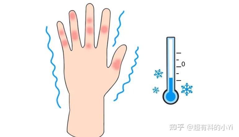 天气越冷越容易长冻疮吗?其实并不是,冻疮的发生还有另一个关键因素 - 知乎