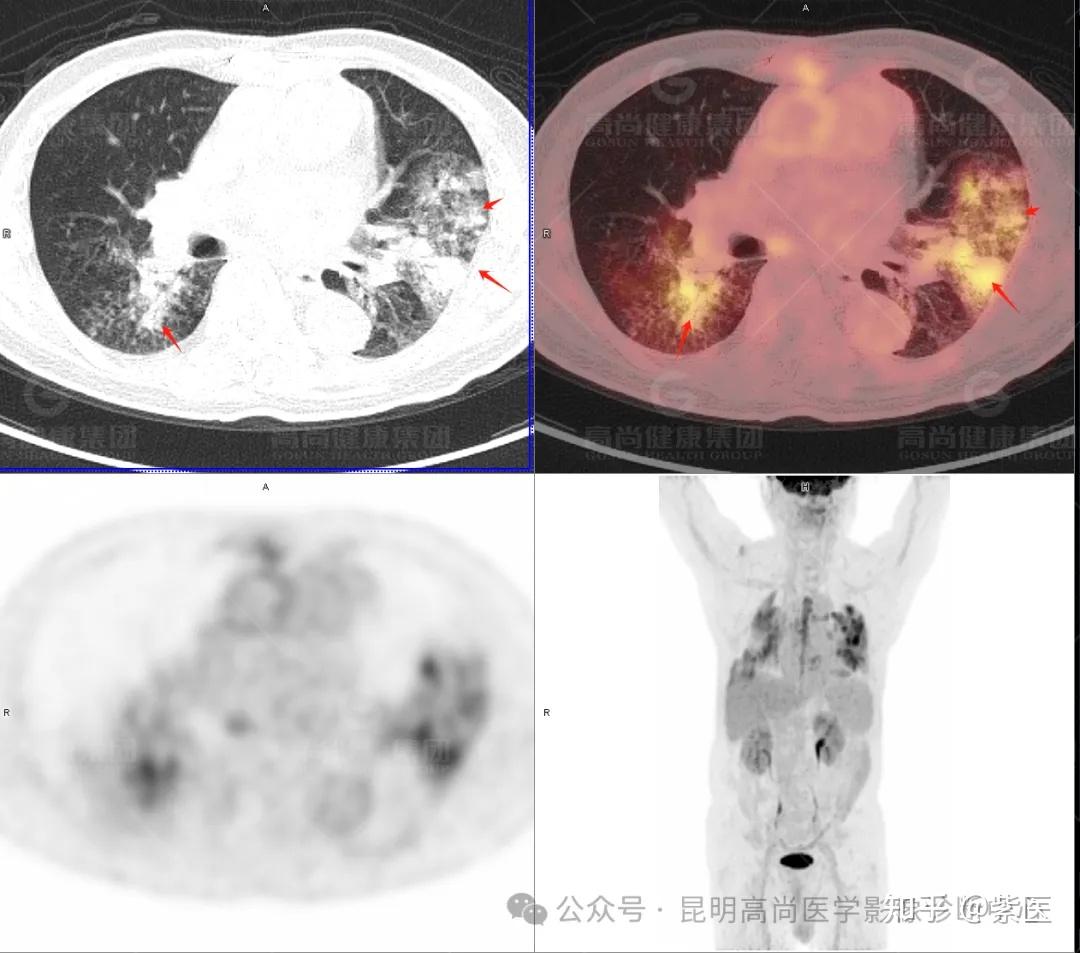 PET/CT诊断肺炎型肺癌 - 知乎