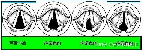 声带一边大一边小图片