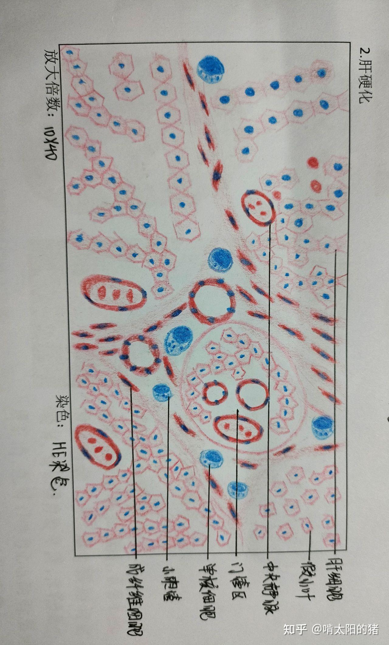 血涂片手绘图淋巴细胞图片
