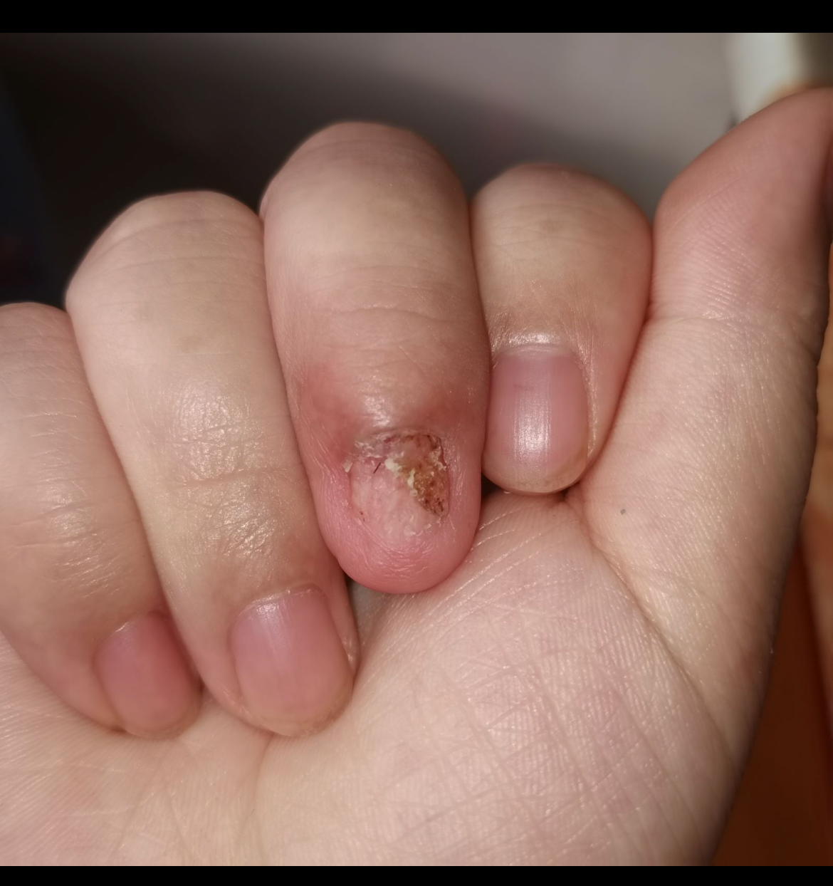 甲下血管球瘤 - 知乎