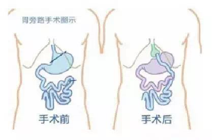 减肥手术哪种下场好_手术减肥_减肥手术有甚么危害