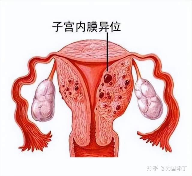 专业试管助孕机构：什么是子宫内膜异位症？子宫内膜异位症的临床表现