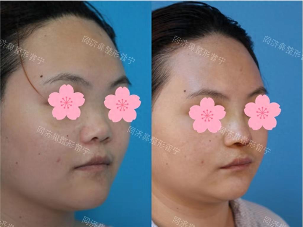 26岁江苏姑娘鼻孔外露,做完鼻综合矫正,自己说朝天鼻消失了! - 知乎