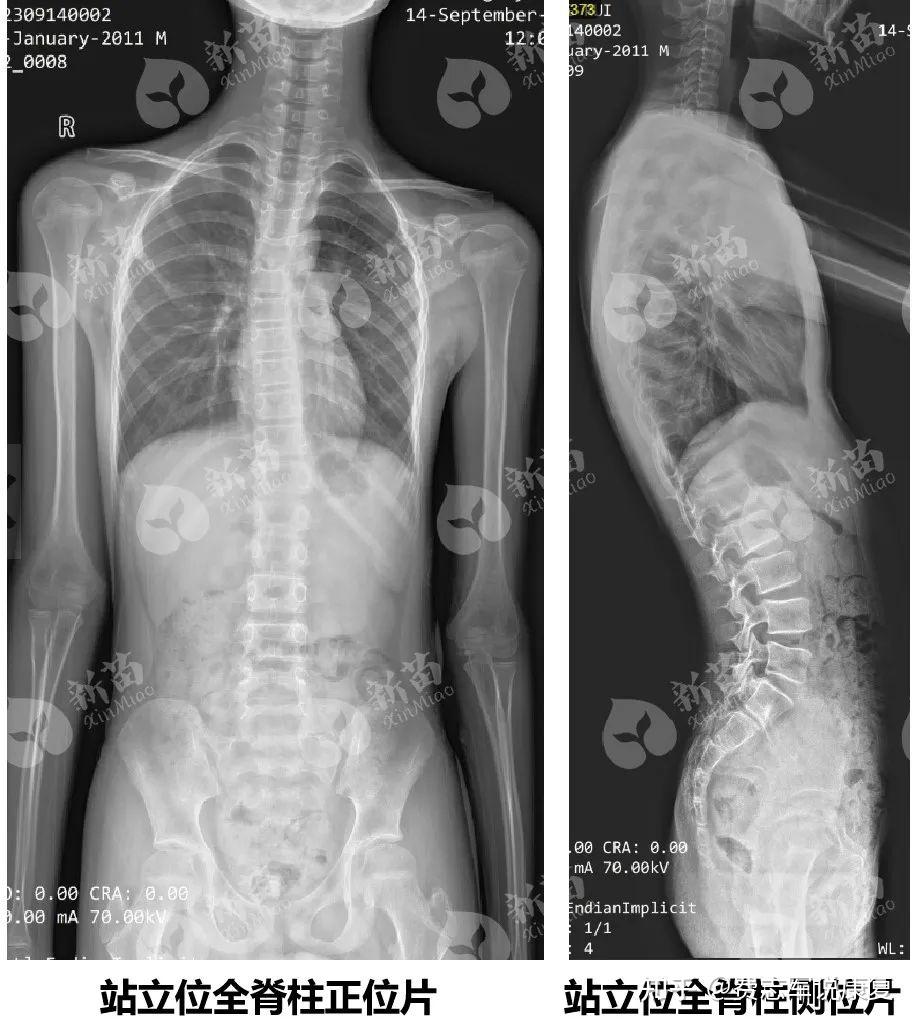 脊柱全景片图片