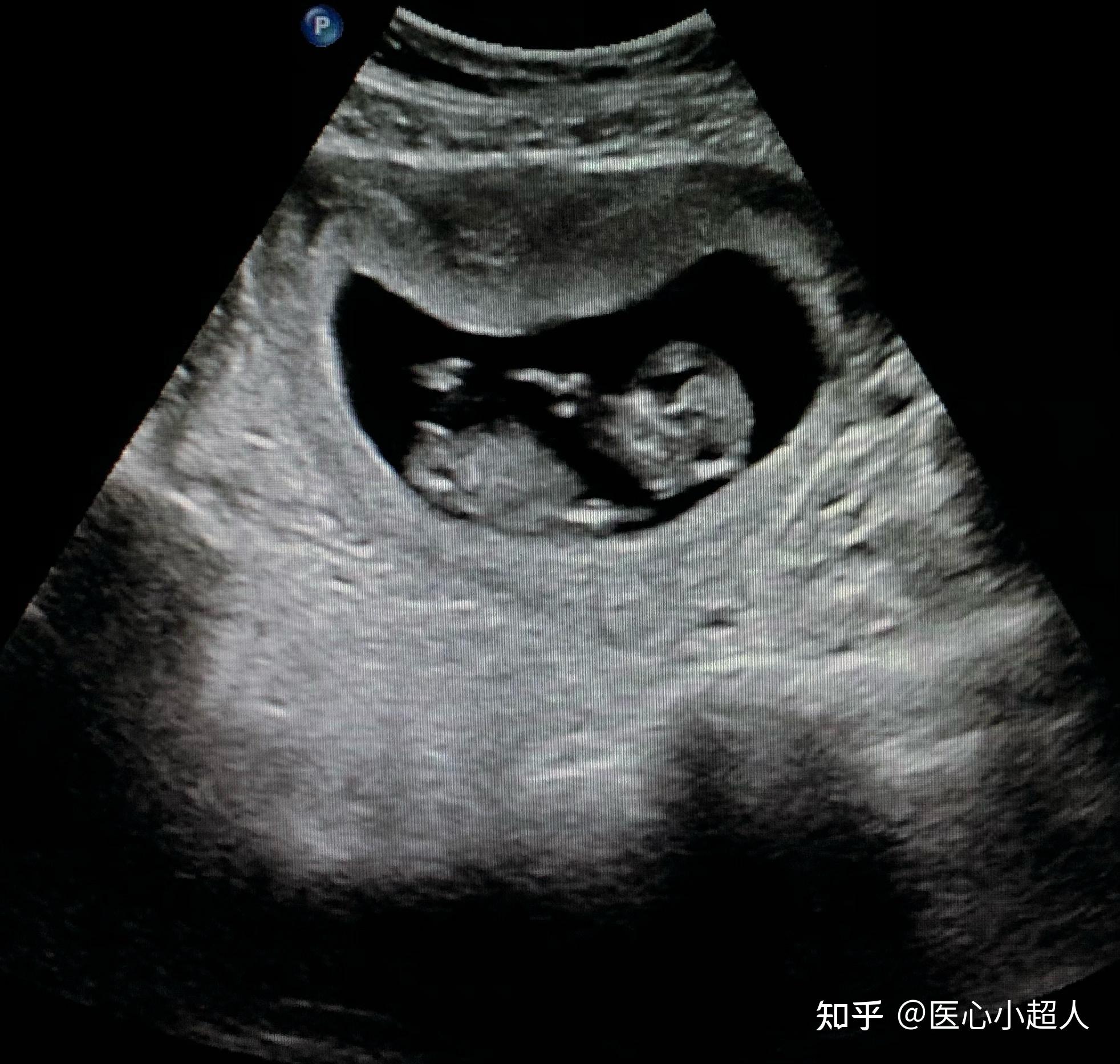正常早期妊娠子宫超声所见（三） - 知乎