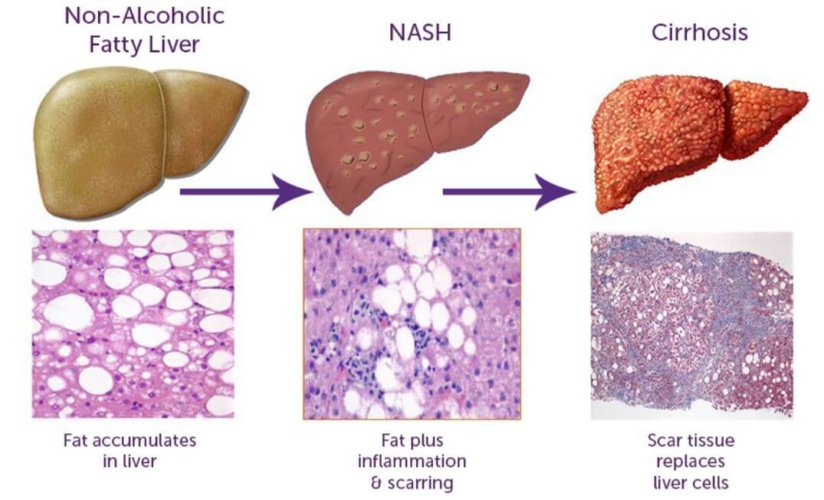 scienceampkcaspase6在非酒精性脂肪肝中肝损伤的作用机制