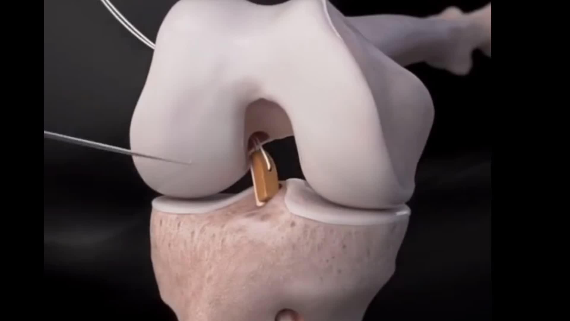 3d动画演示前交叉韧带重建手术