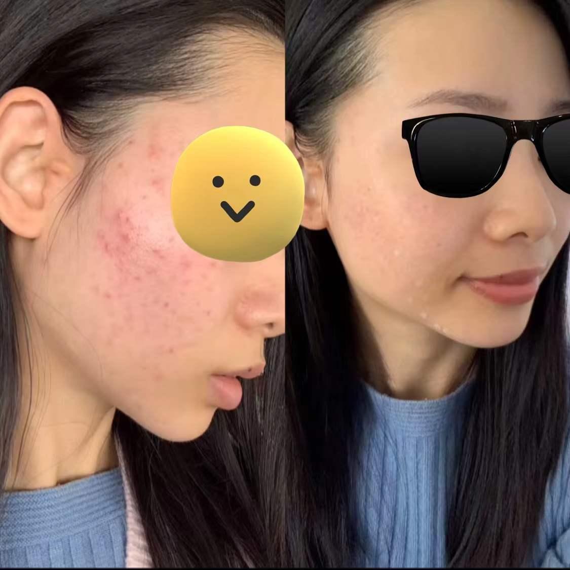 刷酸真的能祛痘吗?