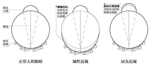 如果从眼球结构改变来说,近视又分为眼轴增长导致近视,角膜曲率导致
