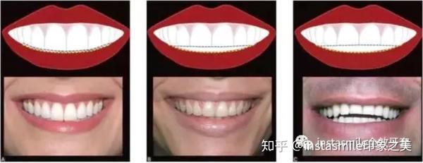 instasmile小课堂丨拥有年轻笑容的秘密 - 知乎
