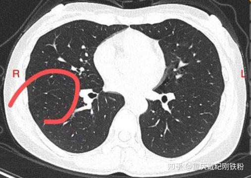 肺磨玻璃结节在胸膜之下一定是胸膜牵拉吗肺结节小伙伴们快搬小板凳儿