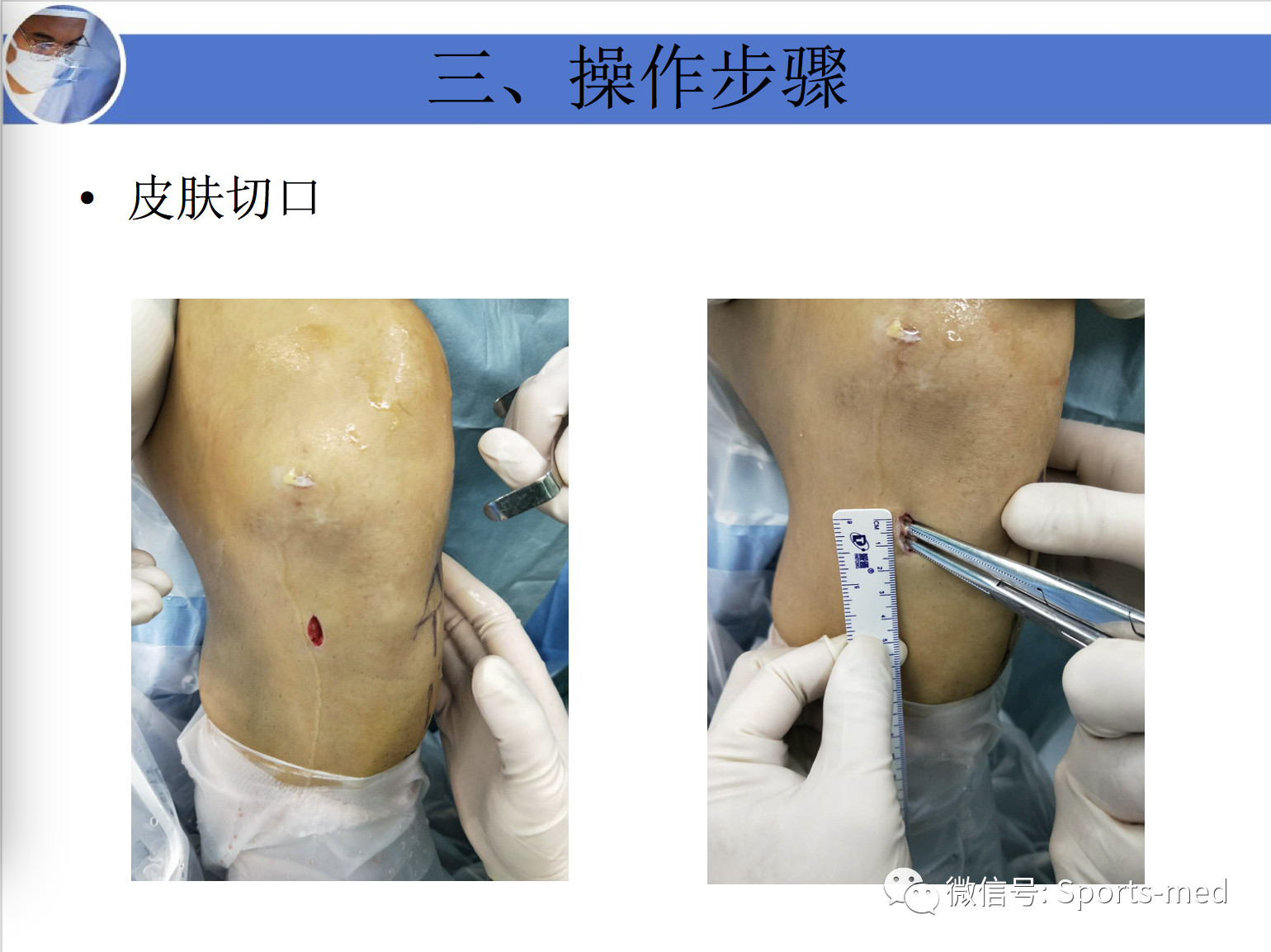 前交叉韌帶重建術中肌腱移植物的準備