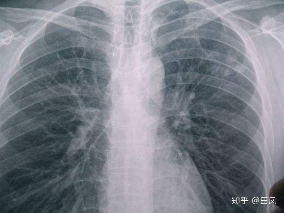 影像学检查中显示的肺部小结节意味着什么