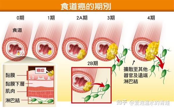 食道癌 知乎