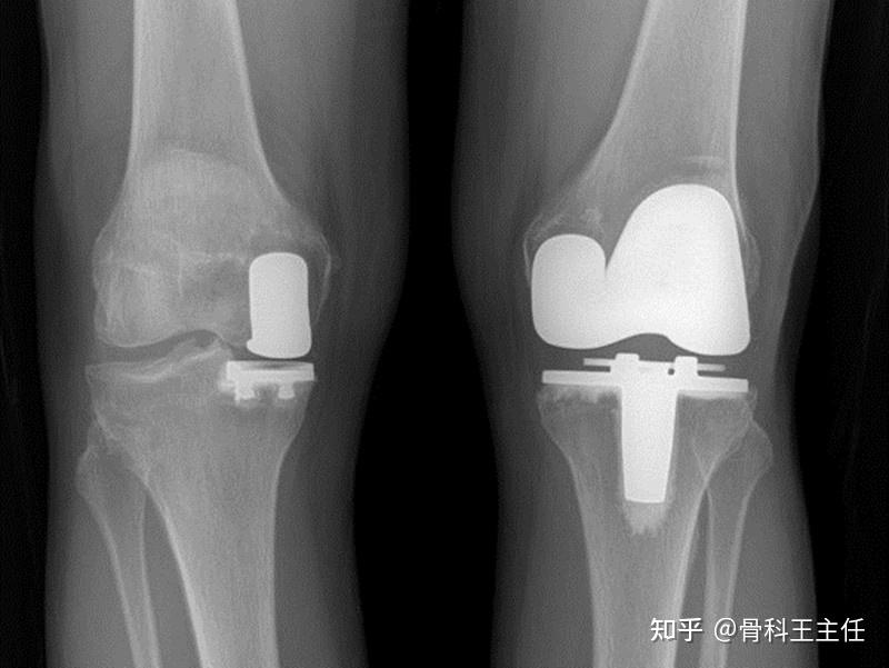 全膝关节置换术