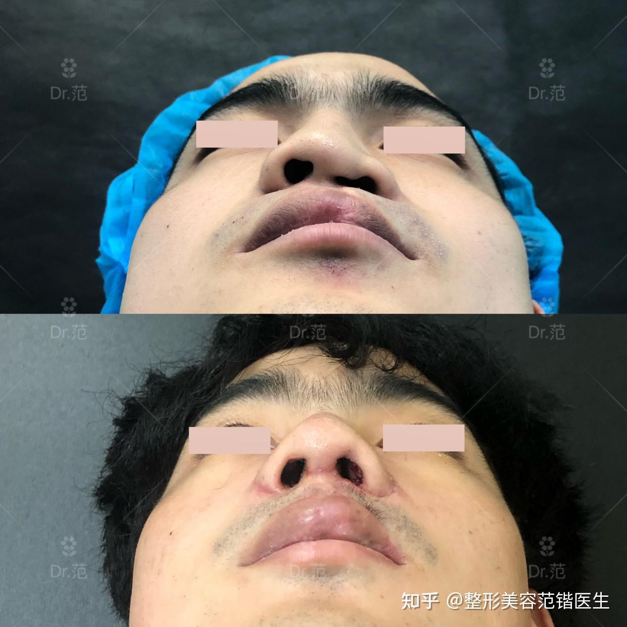 25岁,来自江苏徐州,患有先天性唇腭裂,婴儿时期做了一次修复手术,术后