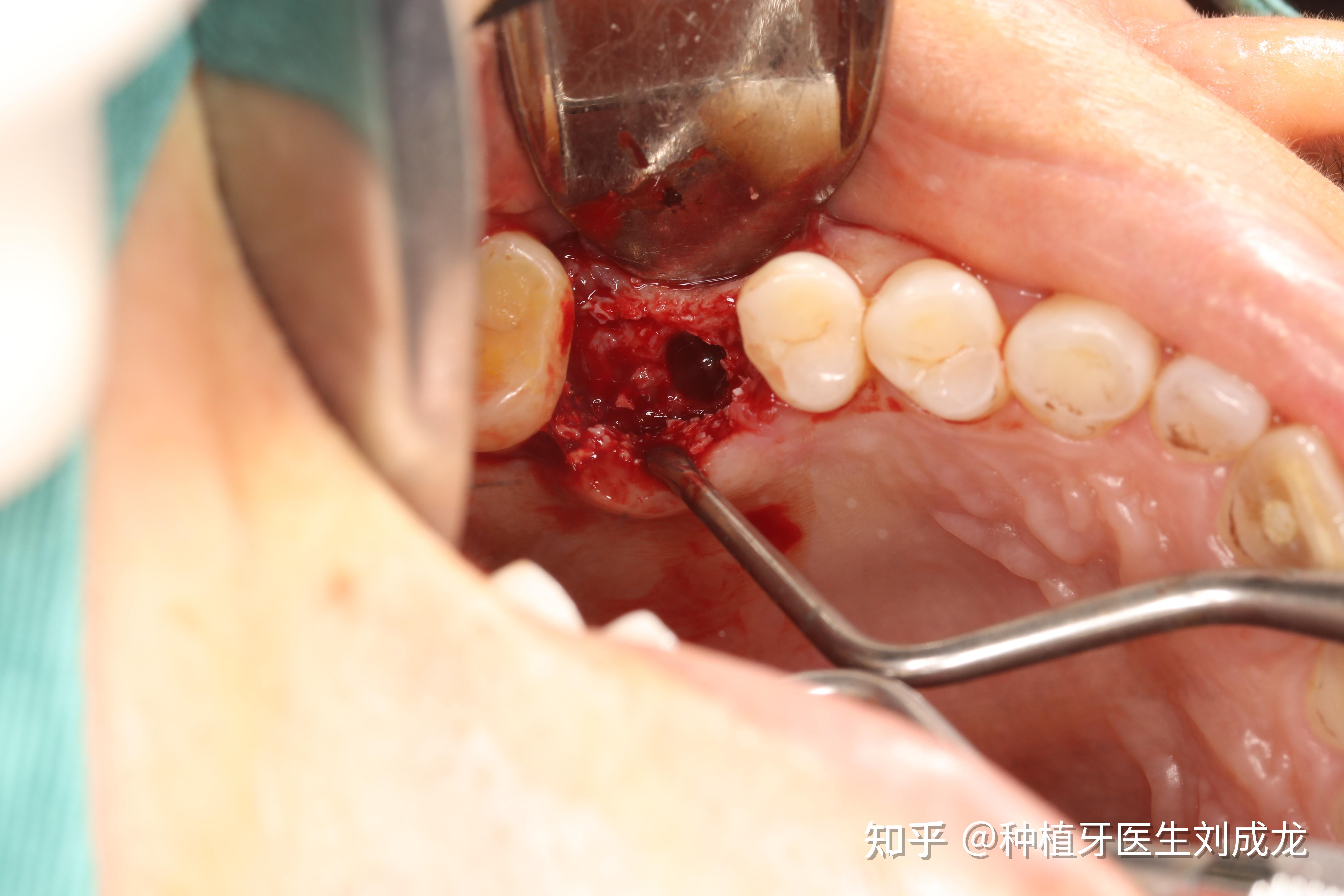 郑州种植牙上颌单颗瑞士iti亲水种植修复案例