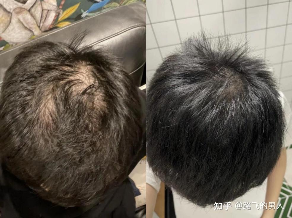 植发地中海(植发地中海有用吗)