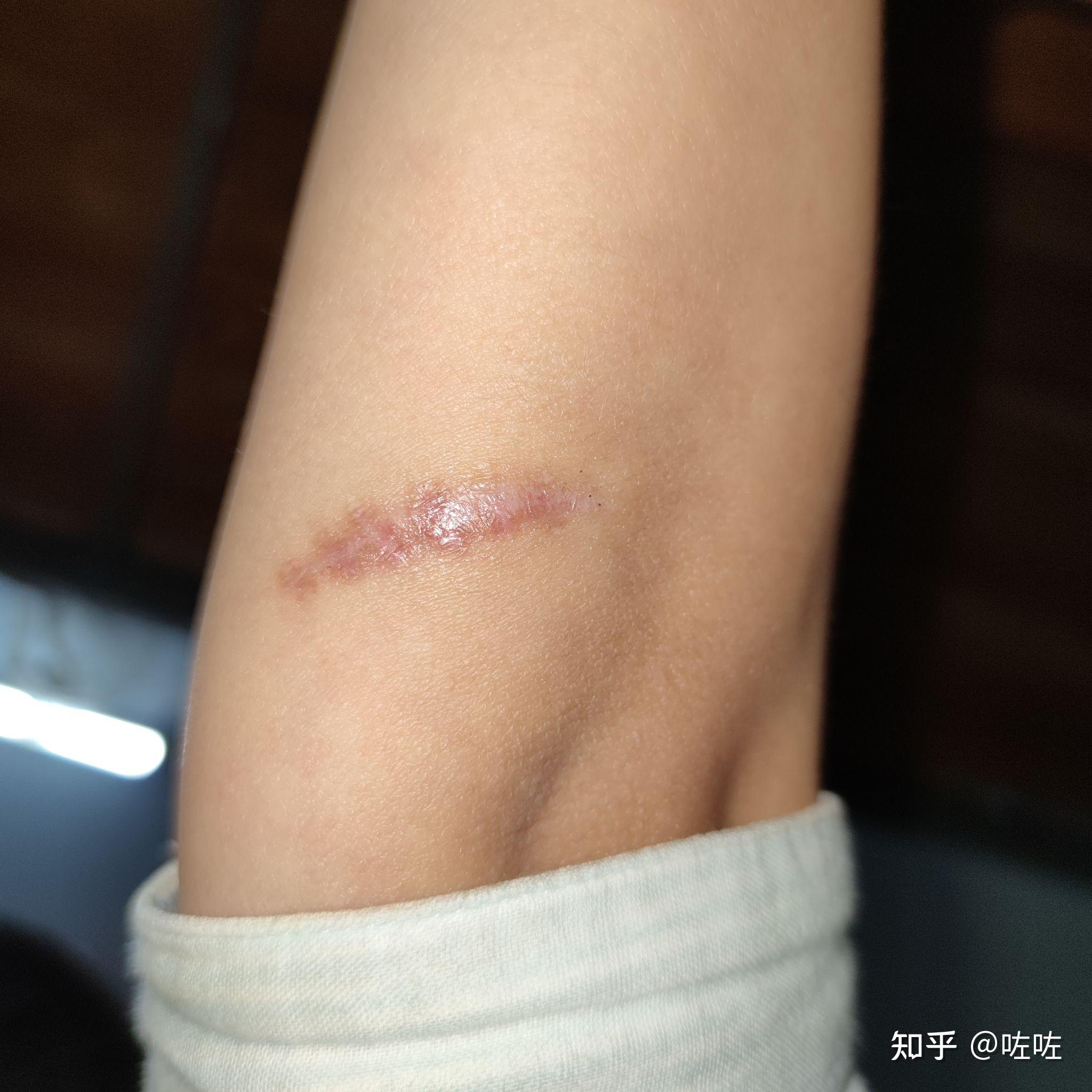 湖南省人民医院谭军疤痕修复 - 知乎