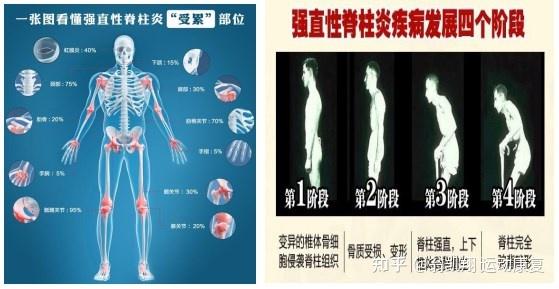 强直性脊柱炎早期有哪些预警信号