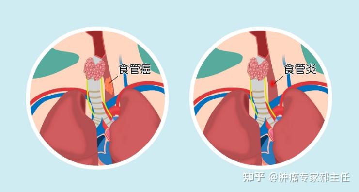 食道癌和食道炎症的区别有哪些? - 知乎