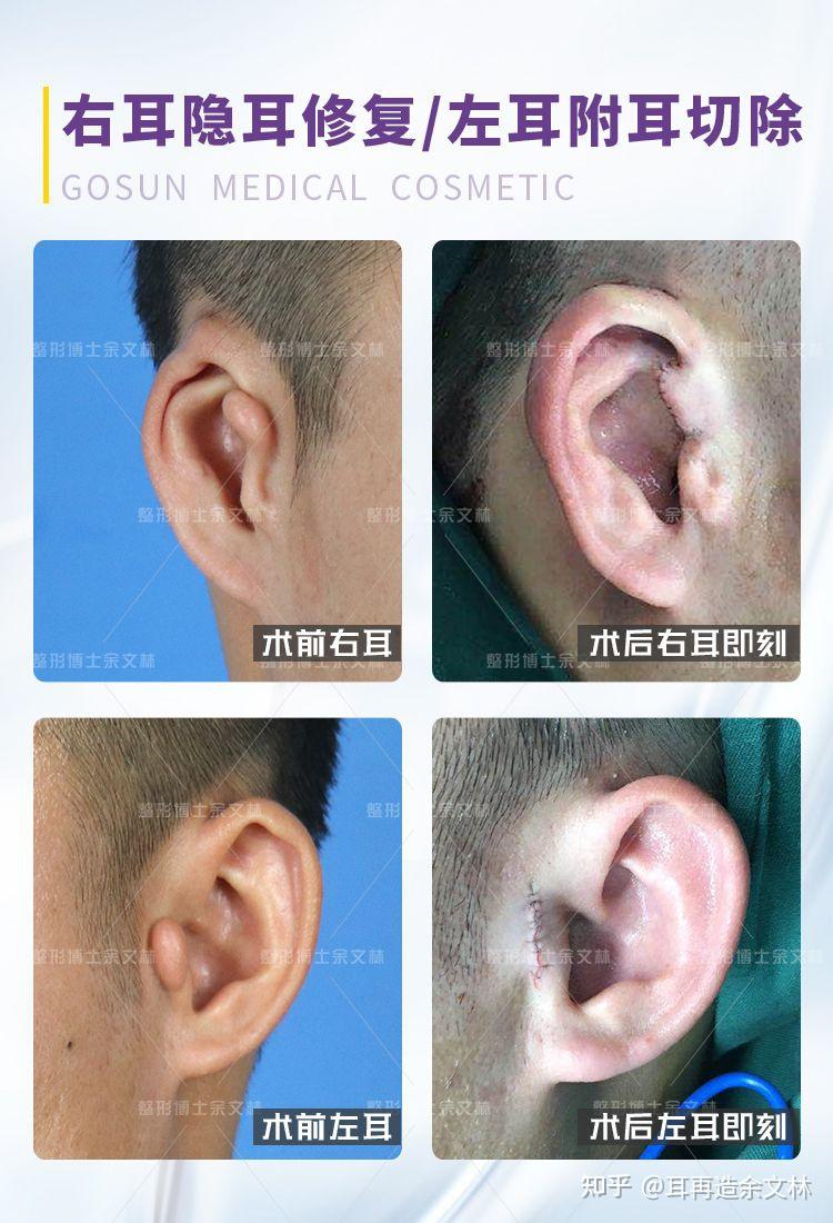 隐耳矫正术后会不会再次缩回去?会不会反弹?