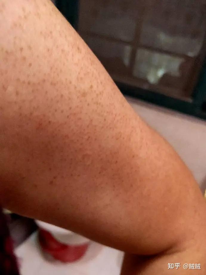 怎么大腿会长鸡皮皮肤(腿上长鸡皮肤怎么办很严重) 怎么大腿会长鸡皮皮肤(腿上长鸡皮肤怎么办很严重)