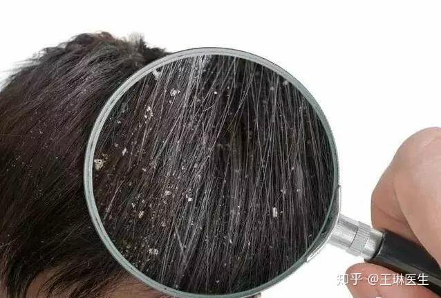“发如雪”的头皮屑怎么办? - 知乎