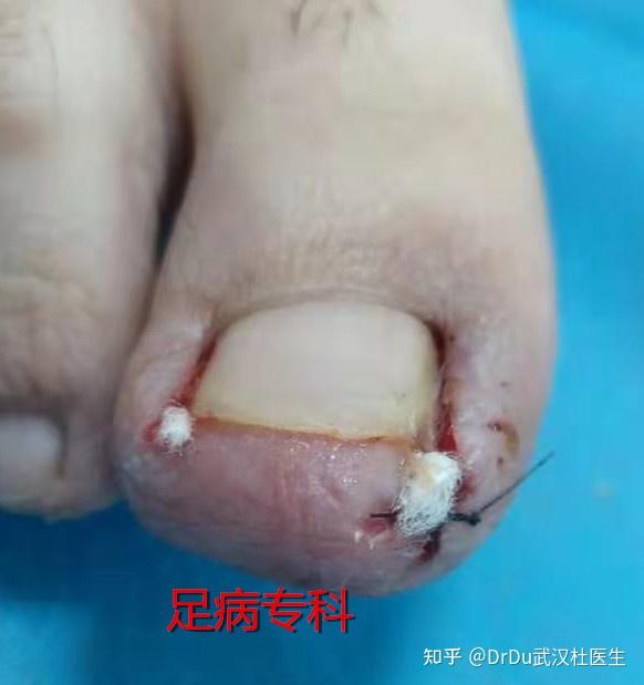 一例双足拇趾甲沟炎的手术病例