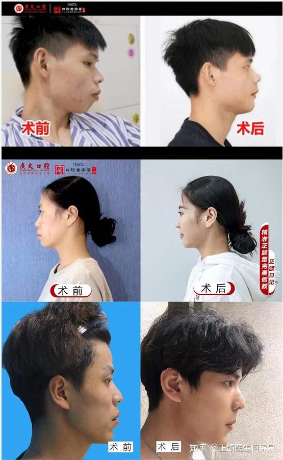 如何判断自己是否存在下巴 …