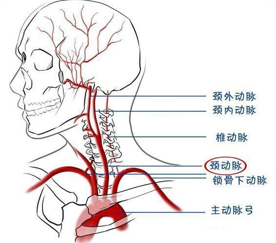 有頸動脈斑塊的人還能跑步嗎斑塊脫落會堵塞血管嗎