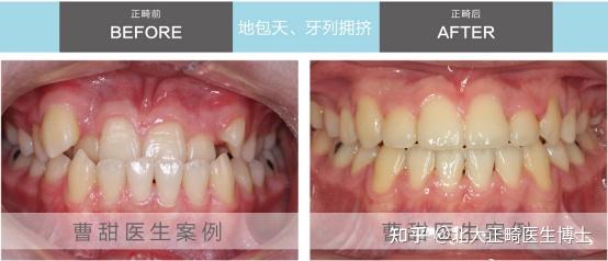 瞭解過正畸的人都知道,