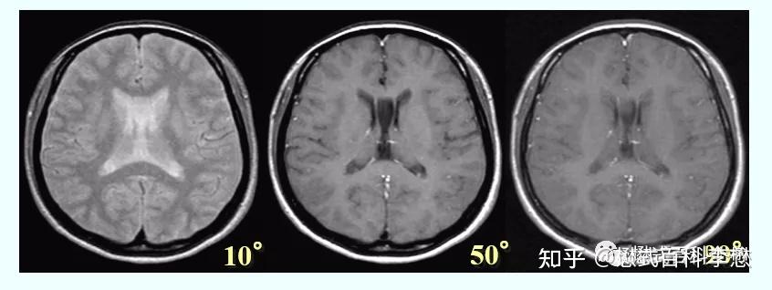 磁共振序列解析之——FFE序列分类 - 知乎