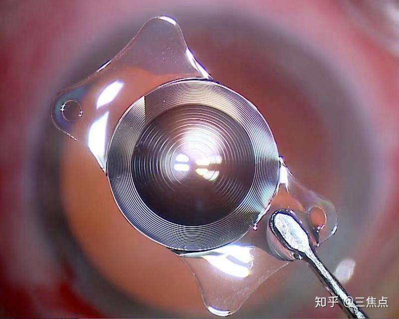 蔡司三焦点分享高度近视又有白内障怎么办