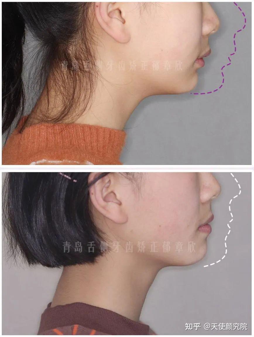 二,孩子凸嘴的自测方法