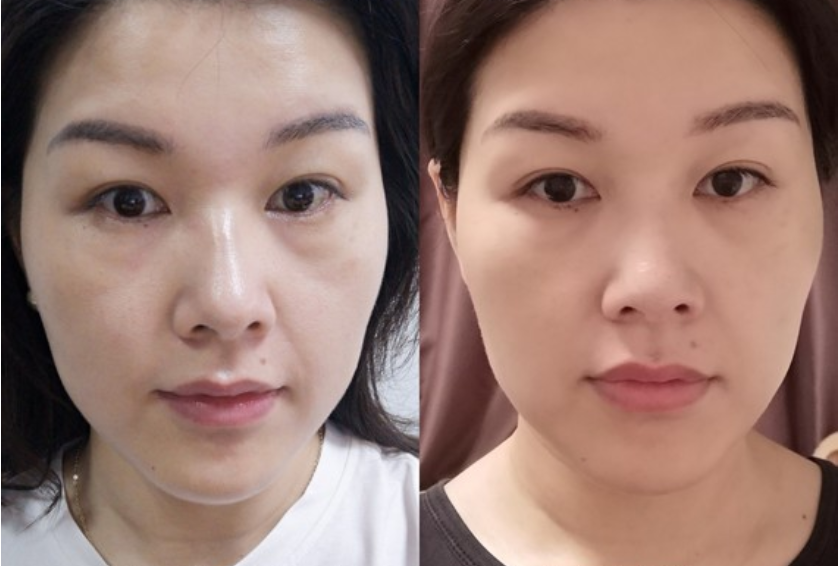 超声炮69与超声刀,7d聚拉缇与热玛吉该怎么选择适合自己的仪器?