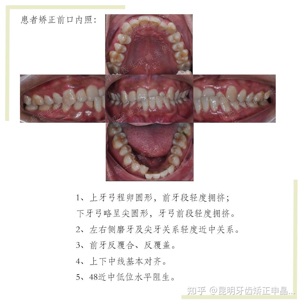 固定矫治器解除反合时可能需要使9296垫活动矫治器或做咬合分离